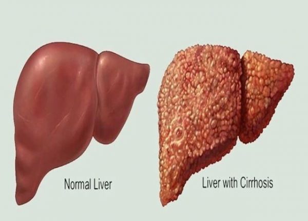 LIVER CIRRHOSIS – LiverTransplantsIndia.in