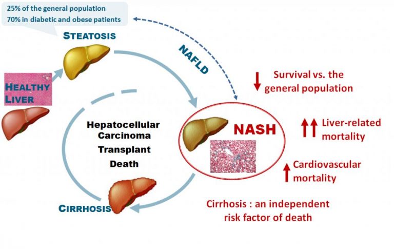 NON ALCOHOLIC FATTY LIVER DISEASE WITHOUT NONALCOHOLIC STEATOHEPATITIS ICD 10 visual data 7