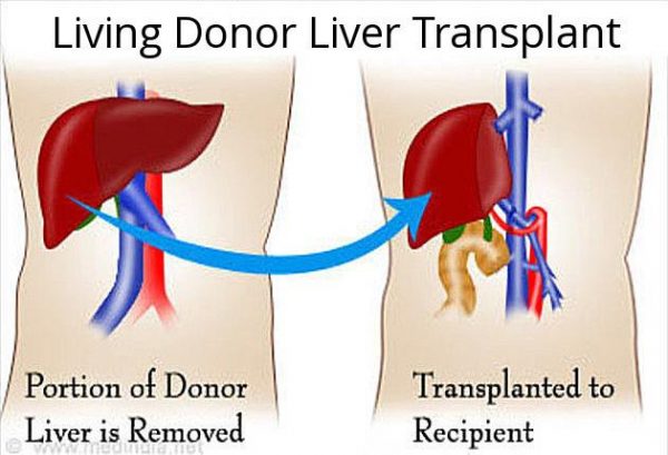 LIVING DONOR LIVER TRANSPLANT – LiverTransplantsIndia.in