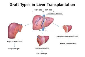 LIVING LIVER DONATION LiverTransplantsIndia In   Ld5 300x200 